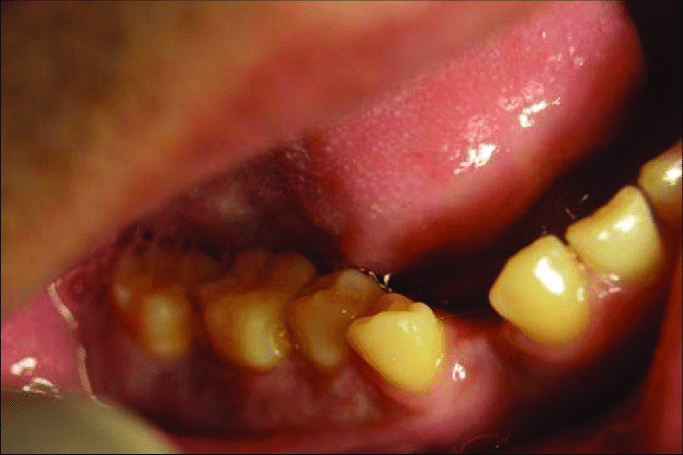 Infrequent radiological features of a dentigerous cyst -A case report